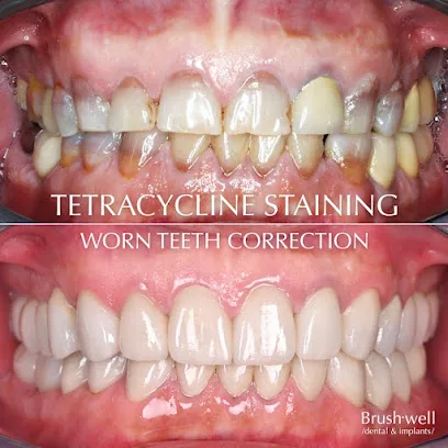 Brushwell Dental & Implants