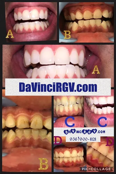 DaVinci Teeth Whitening System RGV