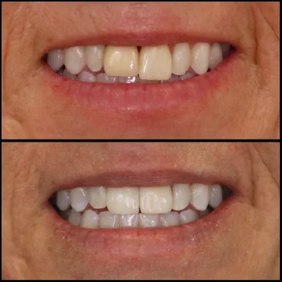 Simply Veneers