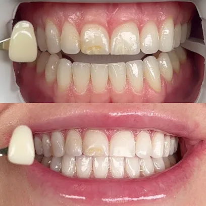 The Coco Blanc Teeth Whitening